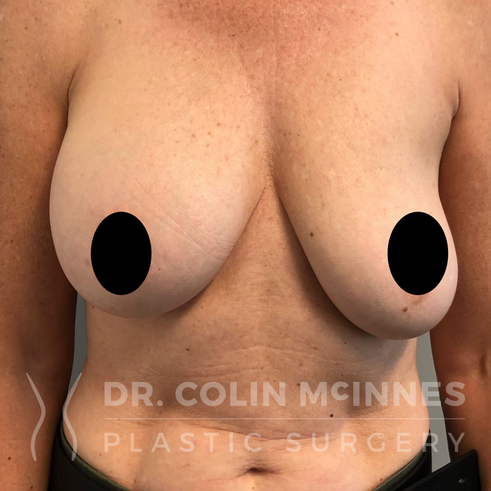 Implant Removal / Capsulectomy & Immediate Lift - BEFORE