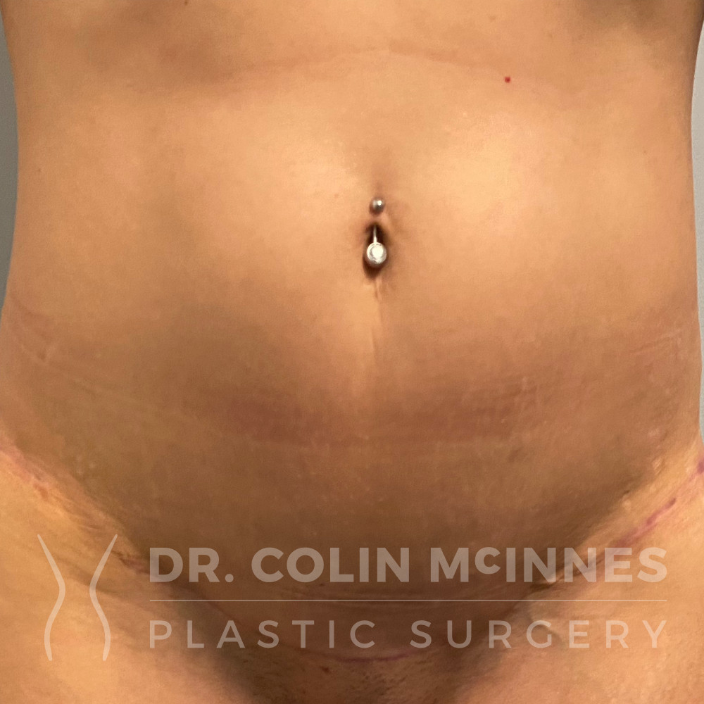 Mini-abdominoplasty - 3 MONTHS POST-OP