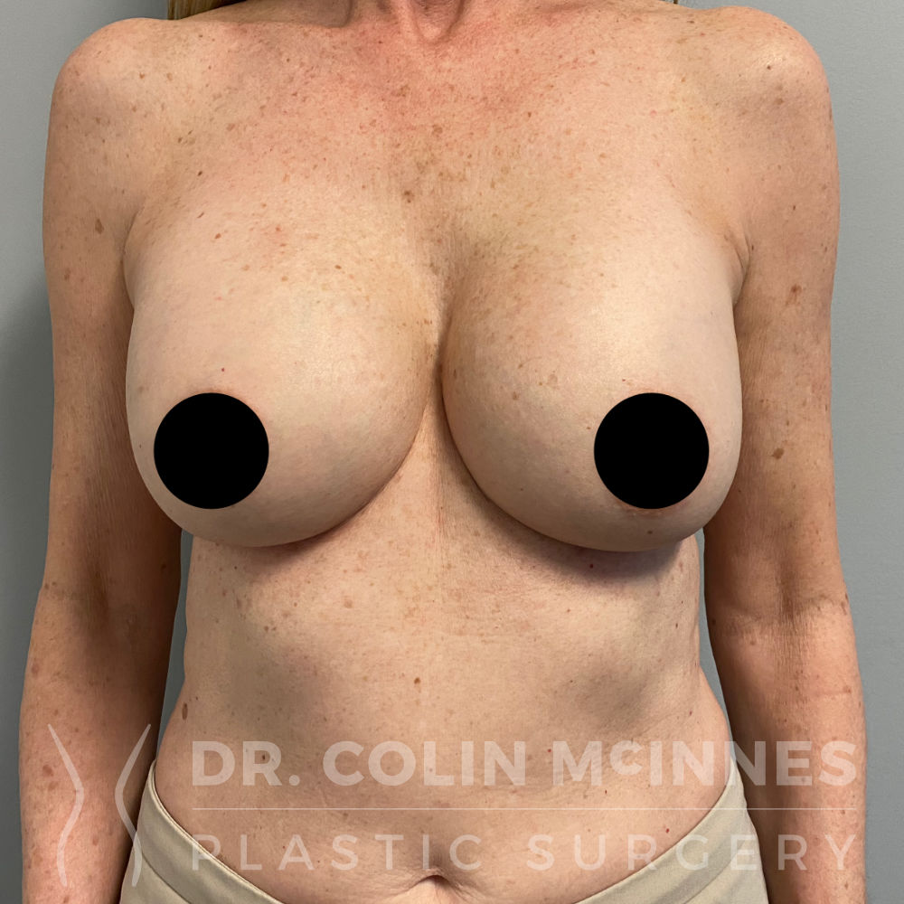 Breast Augmentation w/internal bra support - AFTER