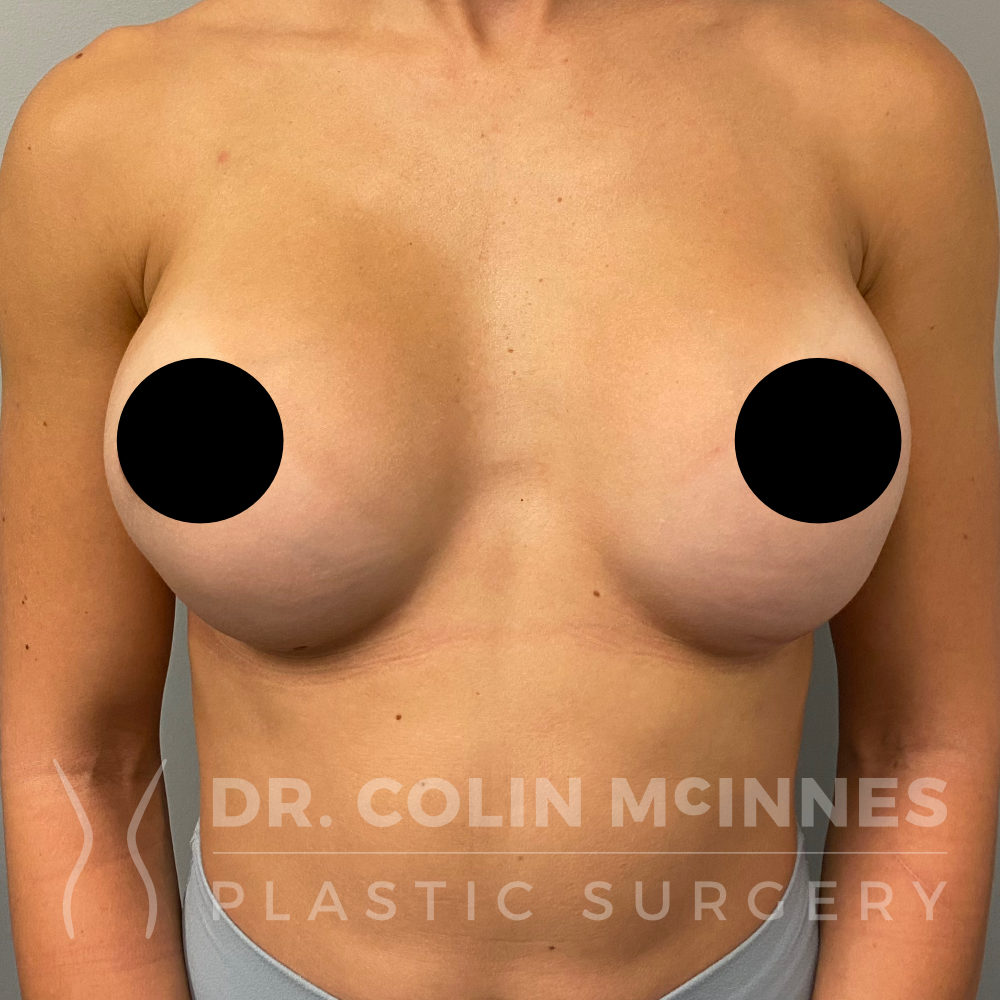 Primary Breast Augmentation - 6 MONTHS POST OP