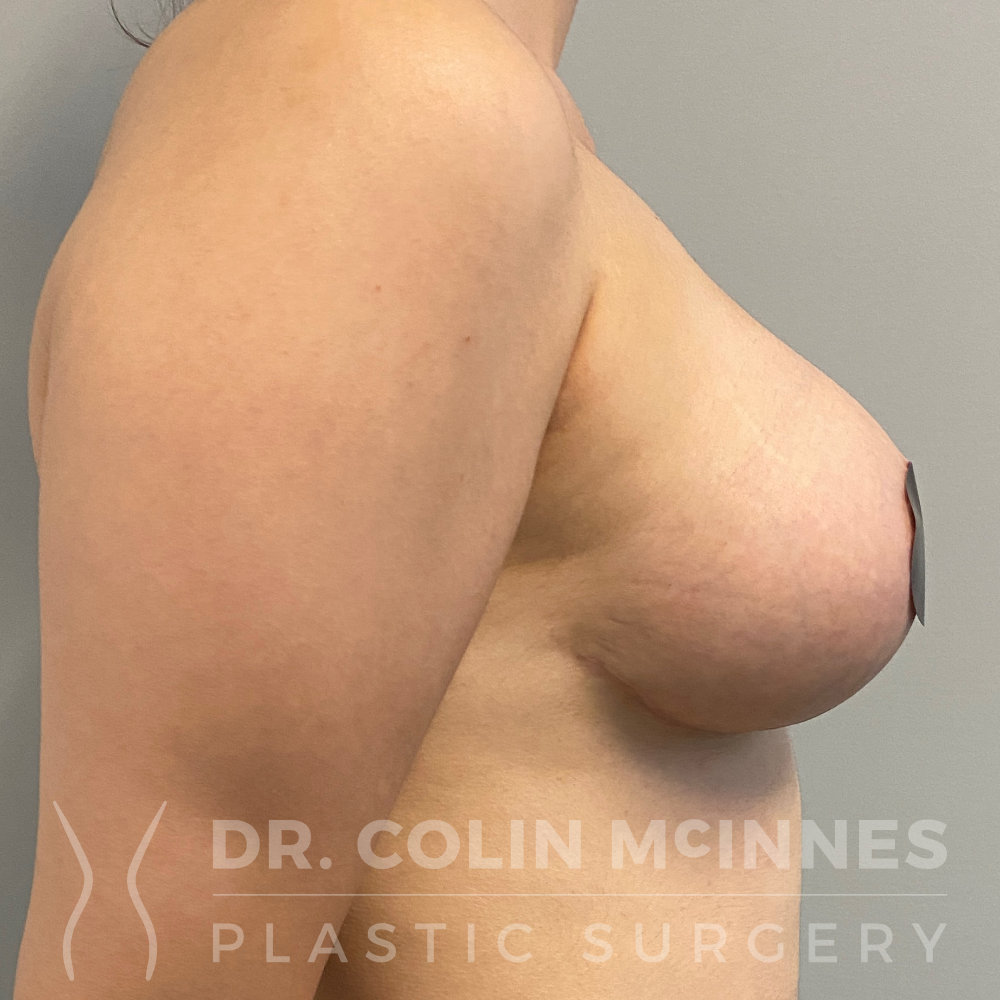 Severe Left Tuberous Breast Deformity - AFTER )3 MONTHS)