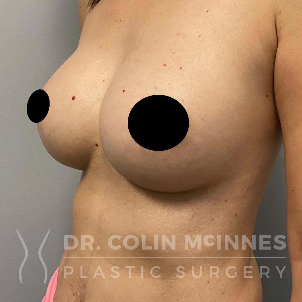 Revision Breast Augmentation - POST OP