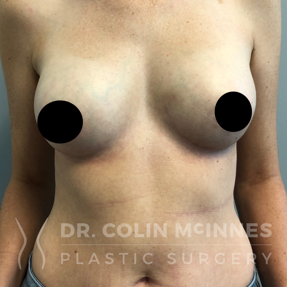 Revision Breast Augmentation - 2 WEEKS POST OP