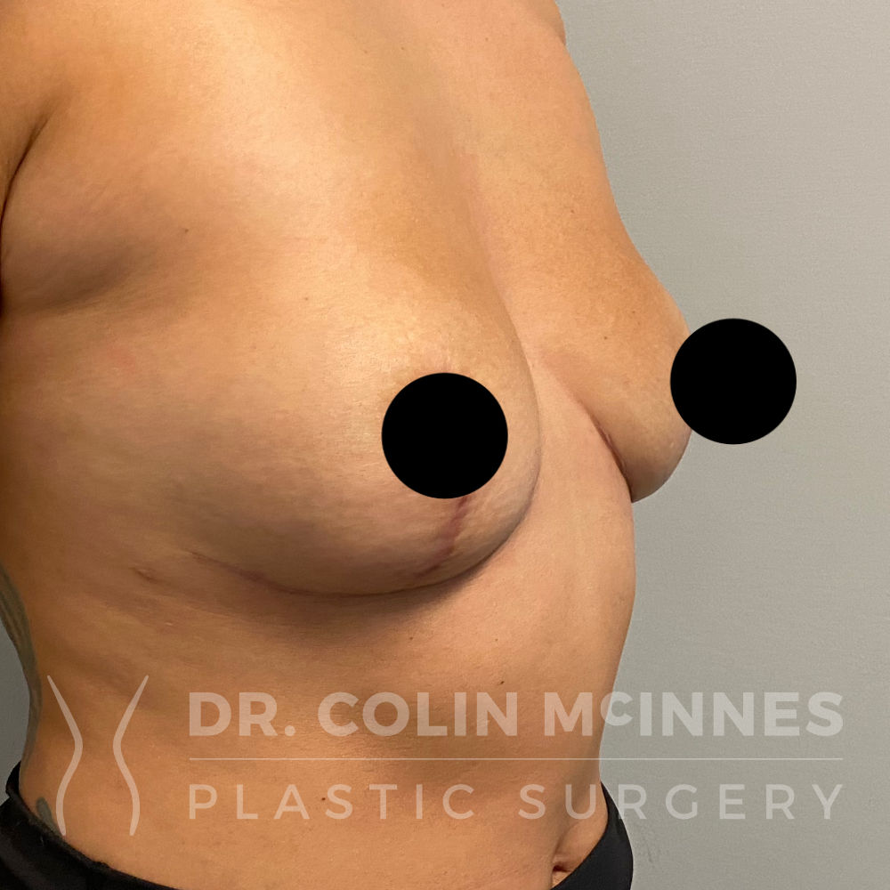 En-Bloc Explant with Immediate Breast Lift - 4 MONTHS POST OP