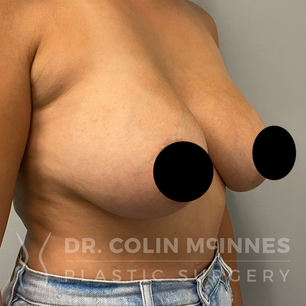 En-Bloc Explant with Immediate Breast Lift - BEFORE