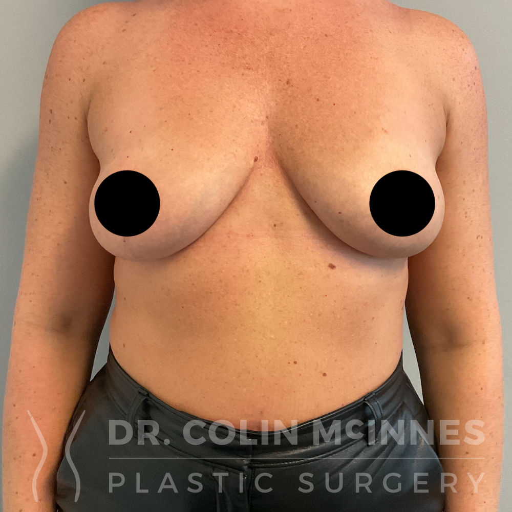 Explant + Mastopexy (Lift) - 21 MONTHS AFTER