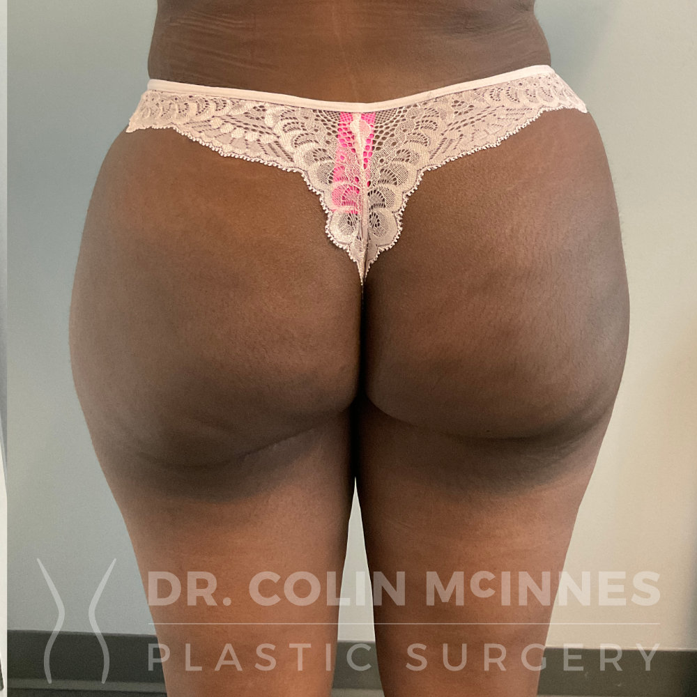 Ultrasound-Guided BBL + Lipo360 - 2 MONTHS AFTER