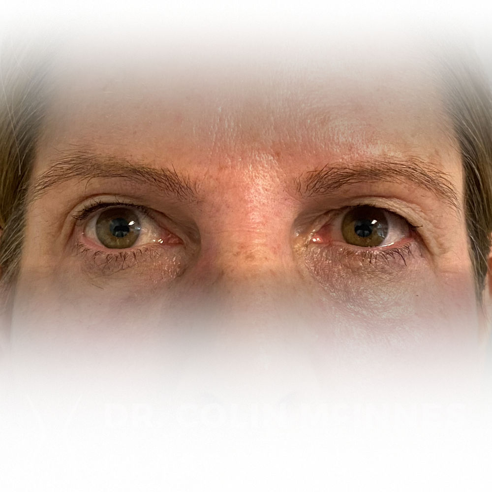 Upper Eyelid Blepharoplasty - BEFORE